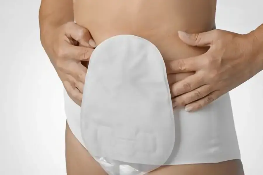 Emplacement des stomies