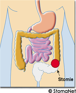 Colostomie Colostomie