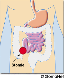 Iléostomie Iléostomie
