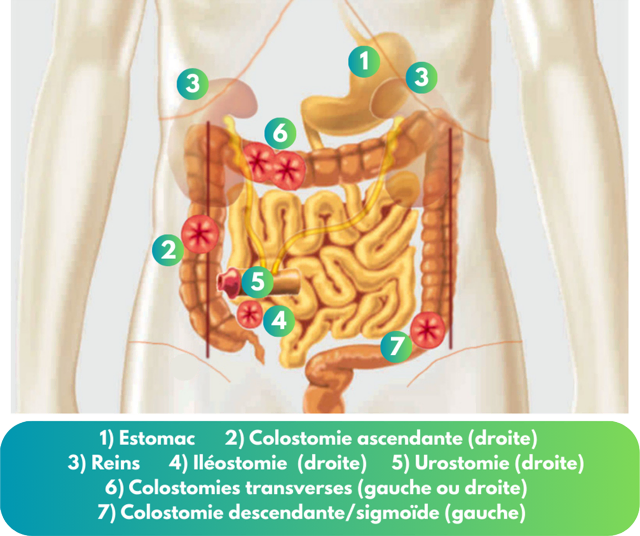 Types de stomies