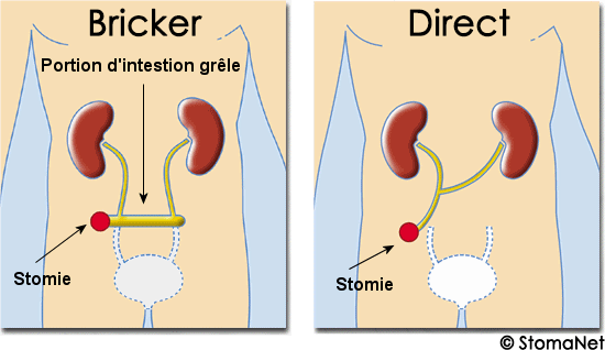 Urostomie / Urétérostomie Les stomies urinaires